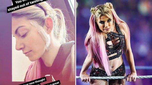 WWE 明星 Alexa Bliss 揭示了皮肤癌的斗争，因为她呼吁粉丝检查是否使用日光浴床