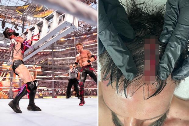 WWE 明星 Finn Balor 在 Edge WrestleMania 比赛中被梯子砸烂后展示了整个头部的可怕伤口