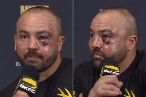 前 UFC 冠军在与“暴力之王”迈克·佩里 (Mike Perry) 的残酷裸拳搏斗中惨遭失败，导致面部严重受伤