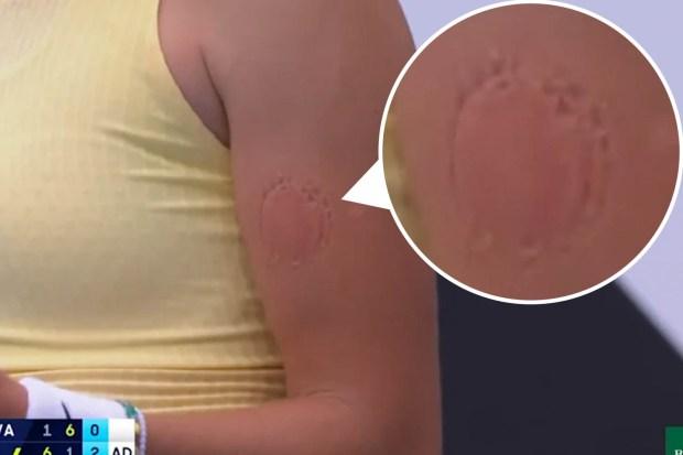 16 岁的澳大利亚网球公开赛明星米拉·安德烈娃 (Mirra Andreeva) 在令人震惊的获胜前愤怒地咬了自己的手臂，展示了可怕的伤疤