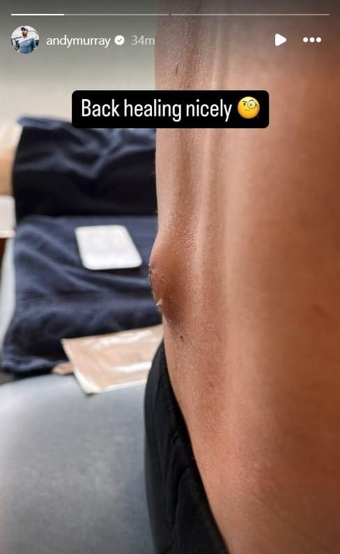 安迪·穆雷在上届温布尔登网球公开赛前脊椎囊肿被切除后痊愈，展示了可怕的手术结果